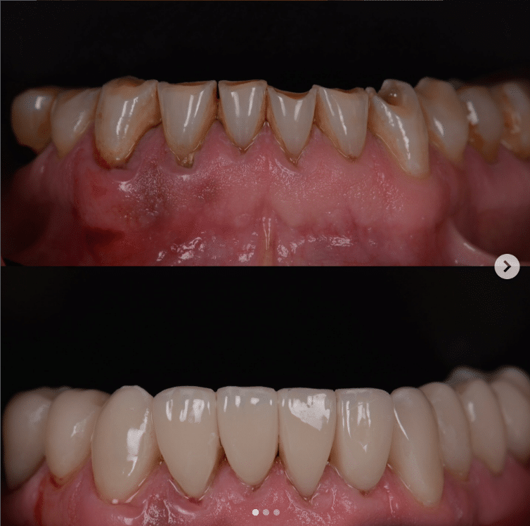 Cerec
