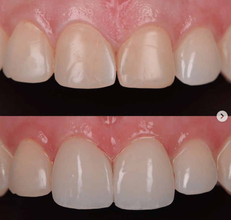 Cerec2